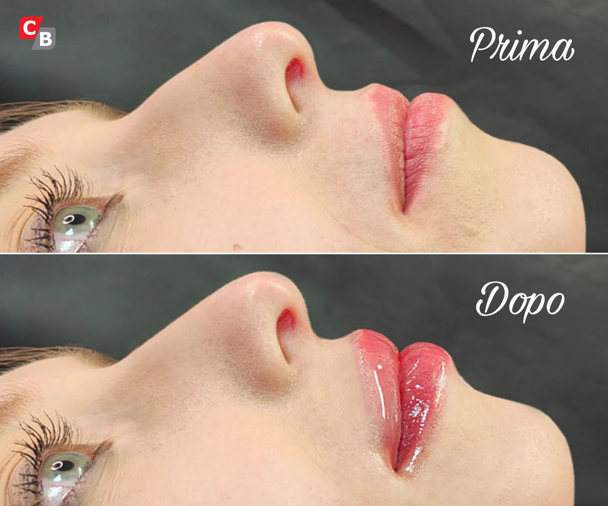 Filler labbra e viso