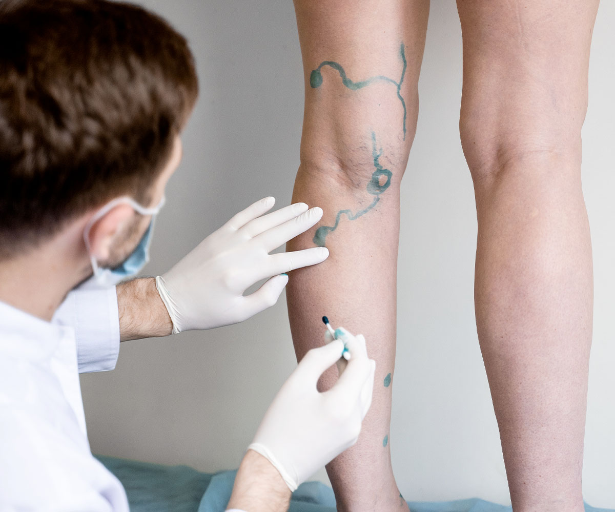 Trattamenti lesioni vascolari